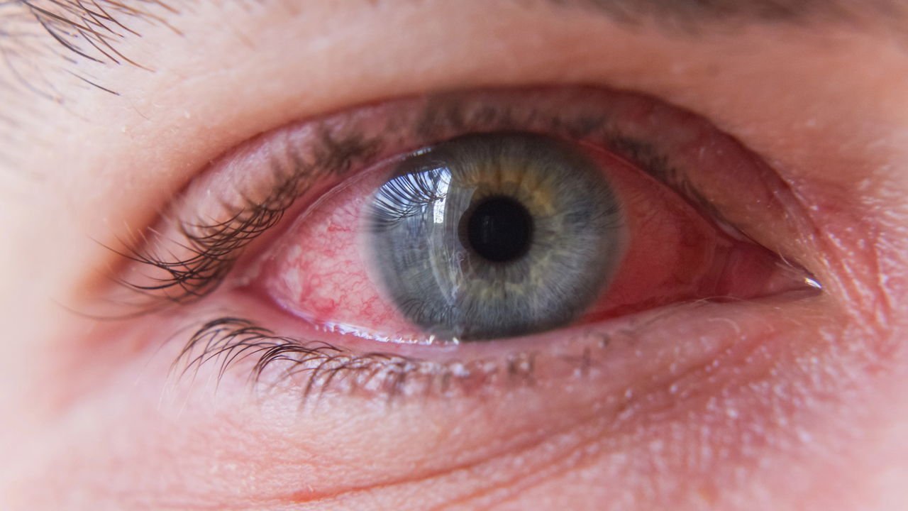 1. Hidraste para Olhos: Benefícios e Riscos do Uso Caseiro
2. Berberina: O Poder Antimicrobiano do Hidraste para a Saúde Ocular
3. Conjuntivite: Alternativas Naturais e Seguras ao Chá de Hidraste
4. Alívio para Olhos Irritados: O Que a Ciência Diz Sobre o Hidraste?
5. Hidraste e Gravidez: Por Que Evitar o Uso nos Olhos?