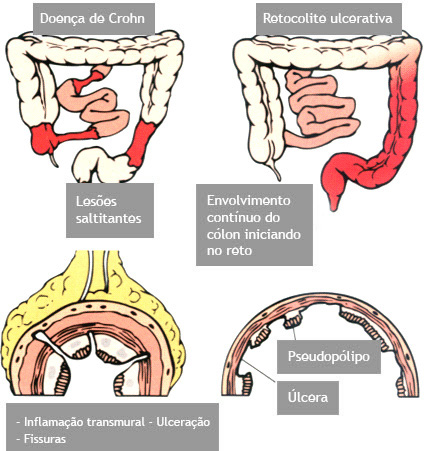 cha para doenca de Crohn e retocolite