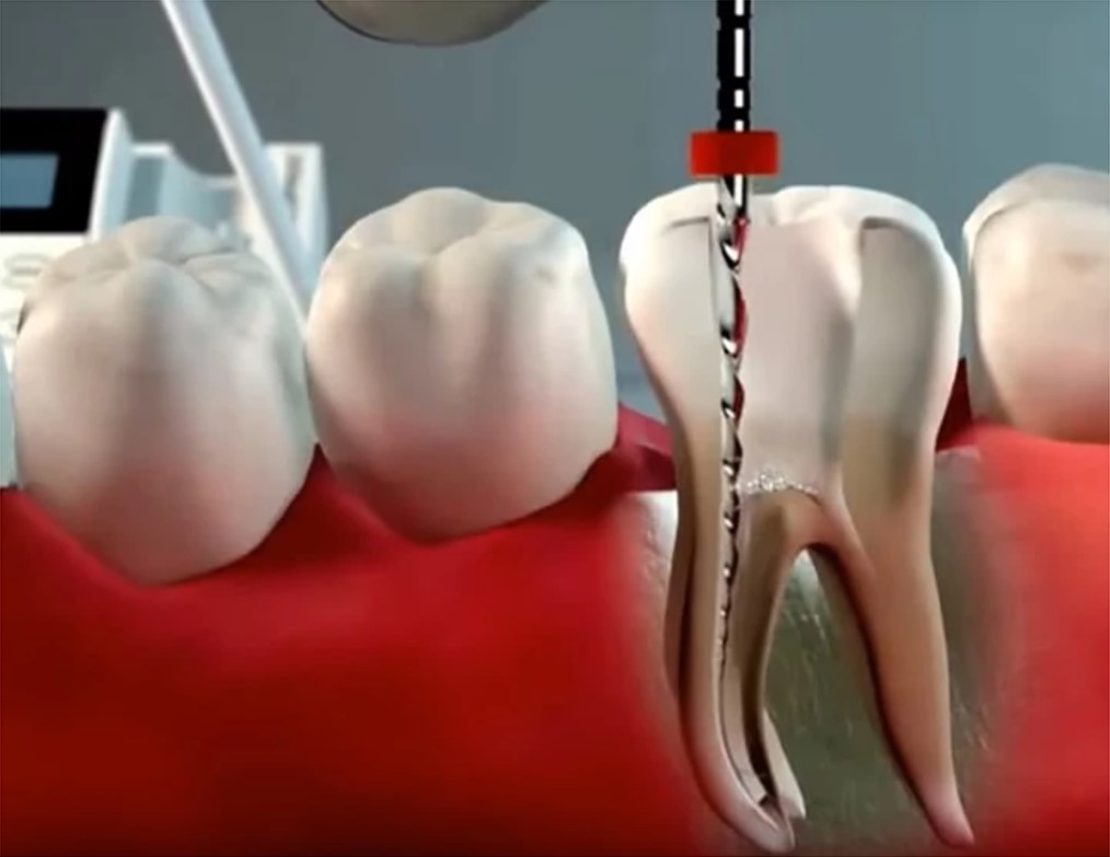 fotos de antes e depois canal no dente