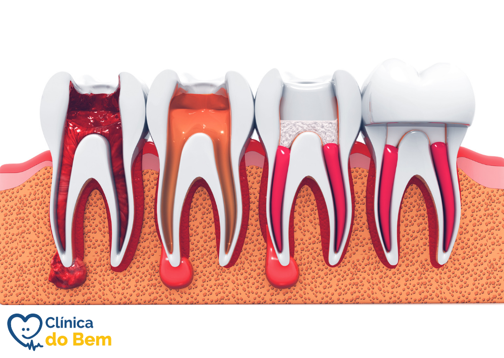 fotos de antes e depois canal no dente