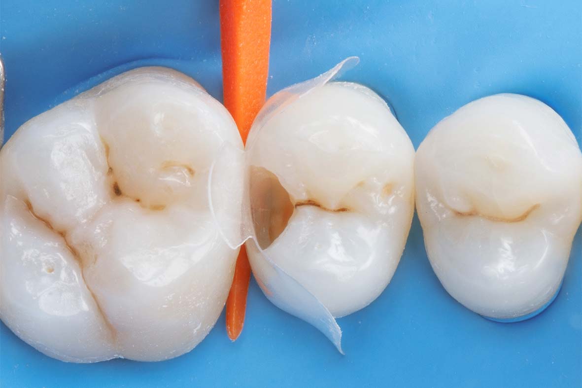 erros comuns ao fazer canal no dente