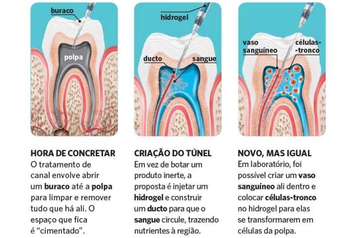 canal no dente vs implante qual o melhor