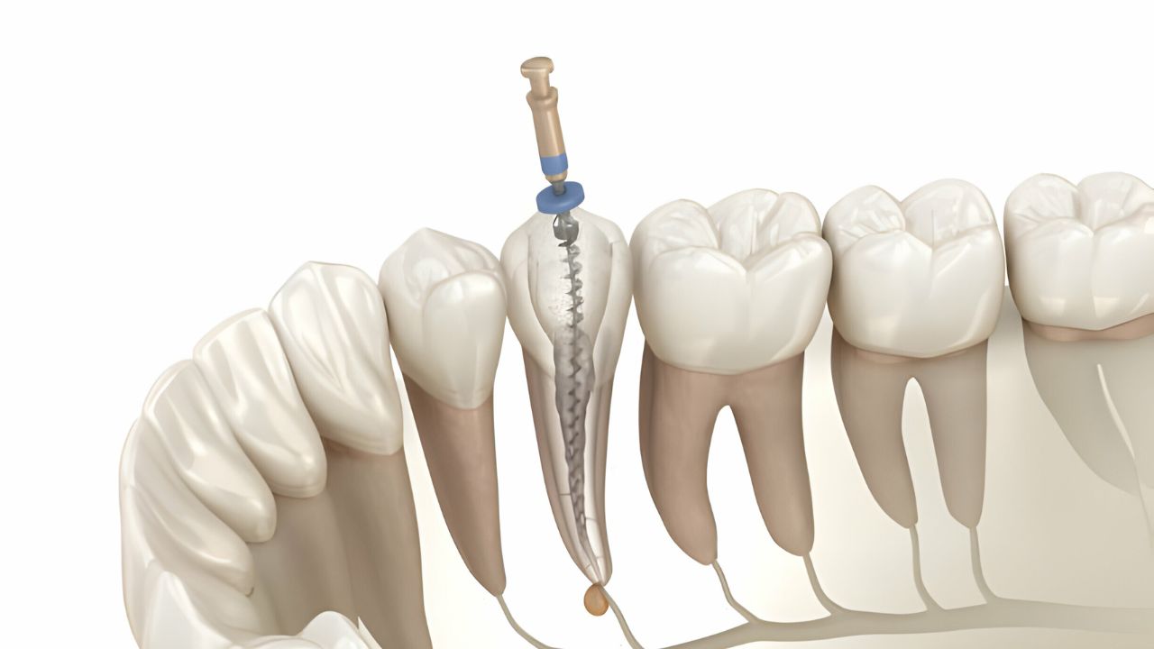 quanto custa um canal no dente