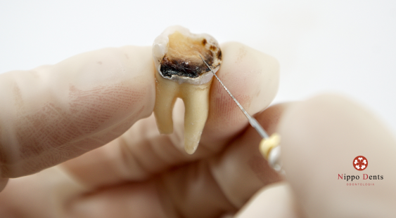 quanto custa um canal no dente