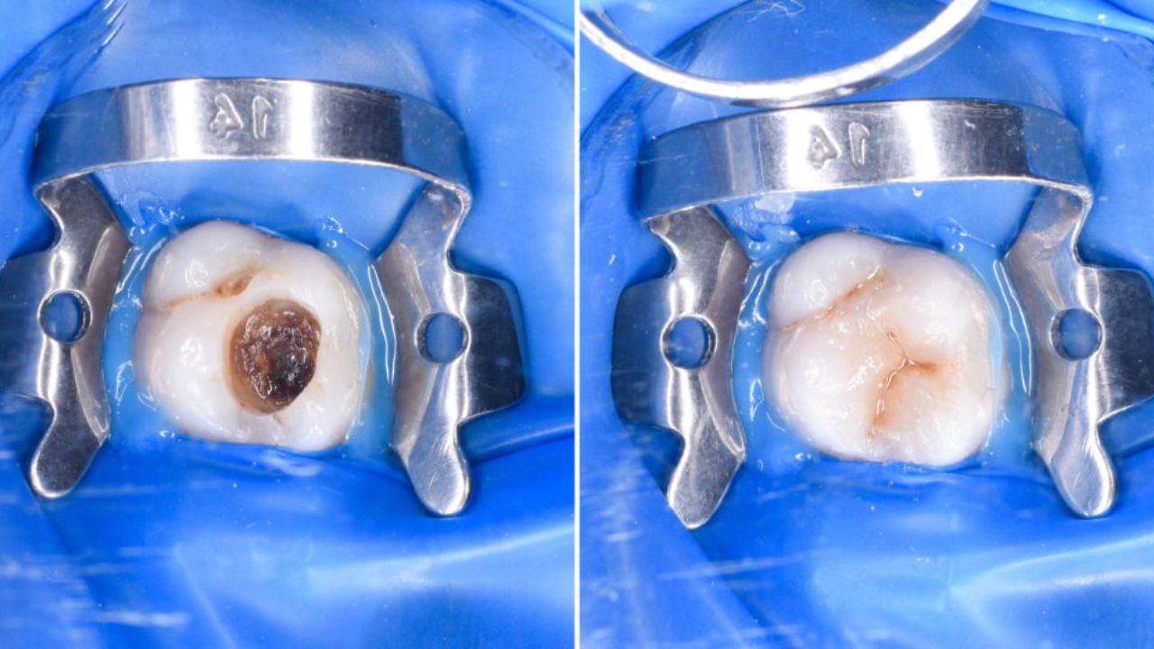 canal no dente vs implante qual o melhor