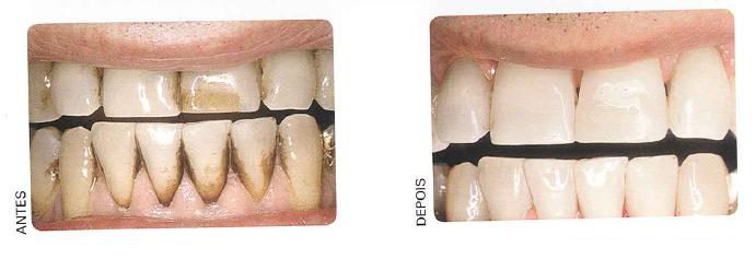 Guia Completo: Como Prevenir Manchas de Café nos Dentes
