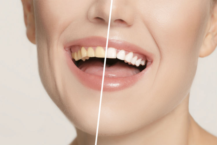 Mitos e Verdades sobre Clarear Dentes com Bicarbonato e Carvão Ativado