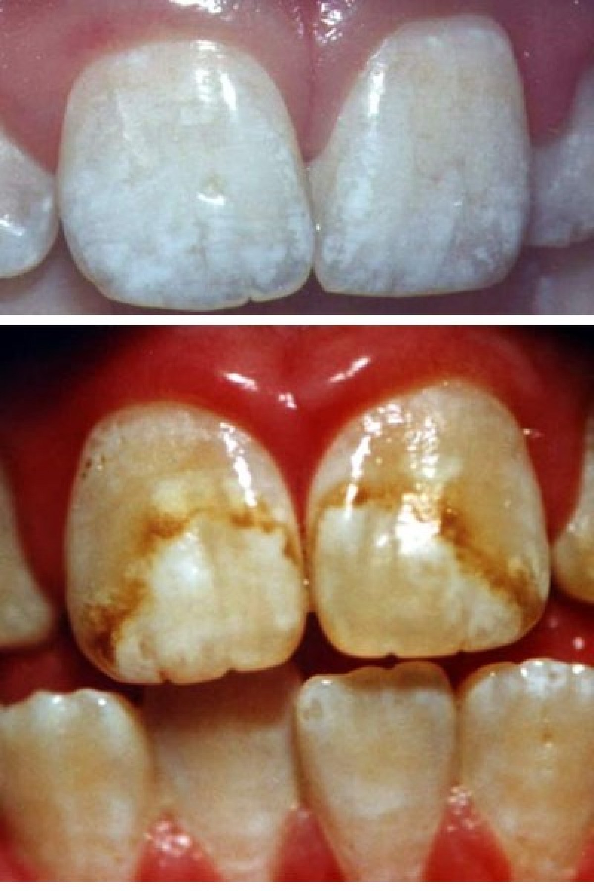 como tirar mancha de café do dente