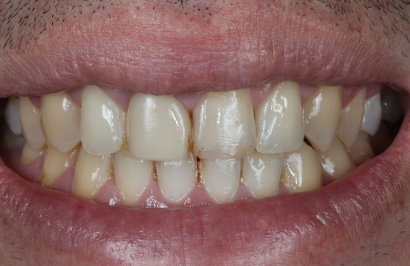 Guia Completo: Como Prevenir Manchas de Café nos Dentes