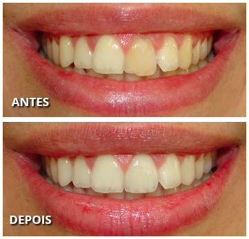 foto em porcelana vs foto em granito